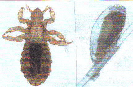 pediculosis. a picture of pediculosis,